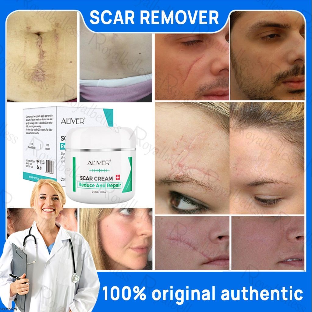 ALIVER Old Scar Remover For Legs 50ml Peklat Remover Acne Surgical