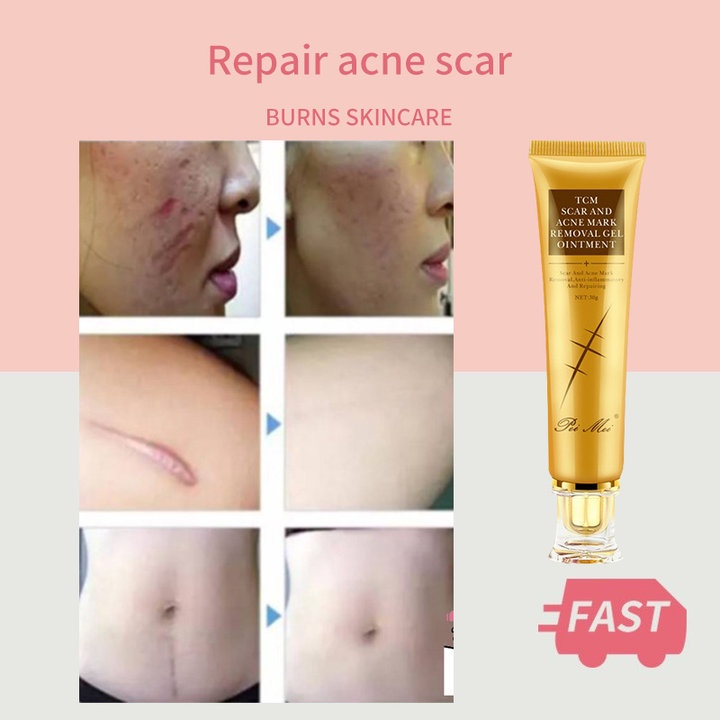 Scar Removal Cream Piklat Peklat Remover Acne Scar Stretch Mark Remover