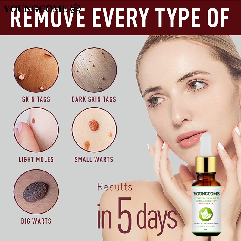 Warts Rover Pure Kasoy Oil Mole Skin Tag Remover By Organic Manila