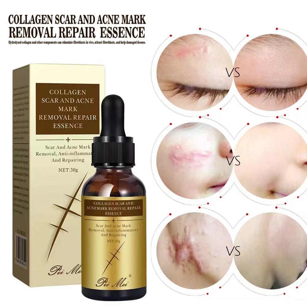 Scar Acne Marks Remover Serum Peklat Keloid Scarminator Cream Treat