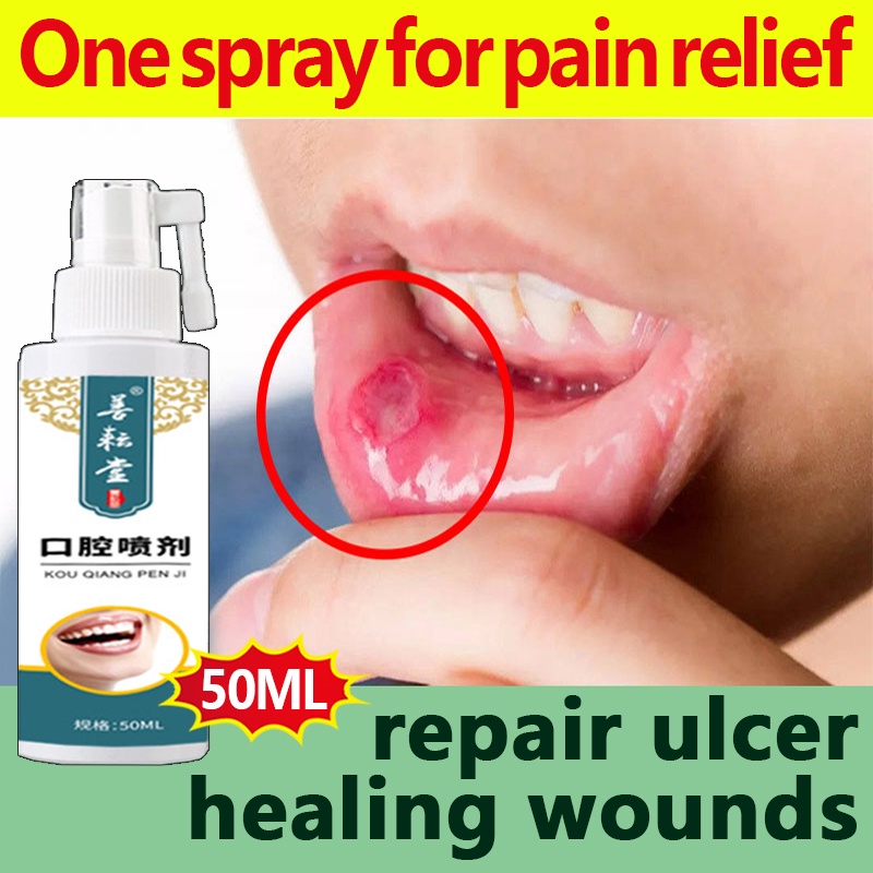 Oral Ulcer Spray Canker Sore Spray Treatment Pharyngitis Halitosis Sore