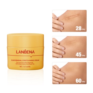 lanbena stretch mark removal