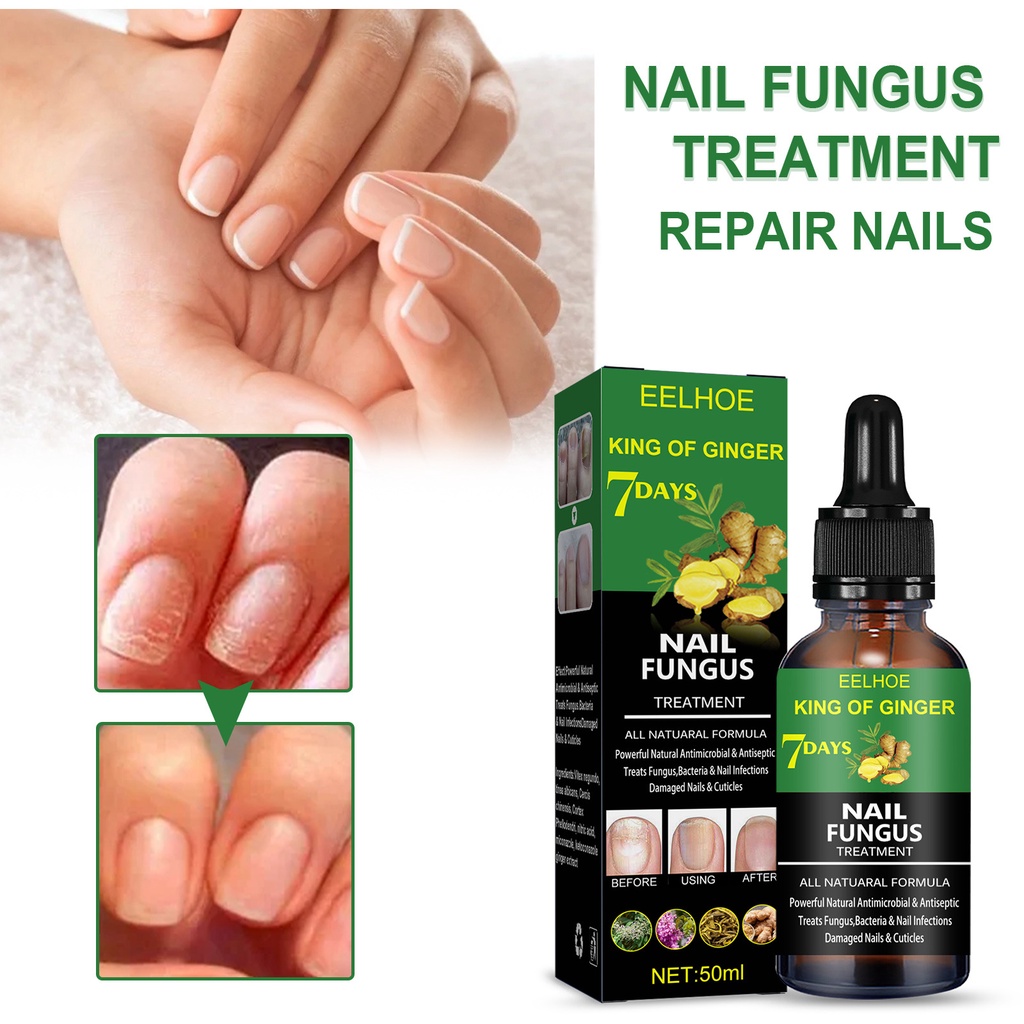 EELHOE Nail Repair Liquid Hand Foot Care Onychomycosis Brightening Soft ...