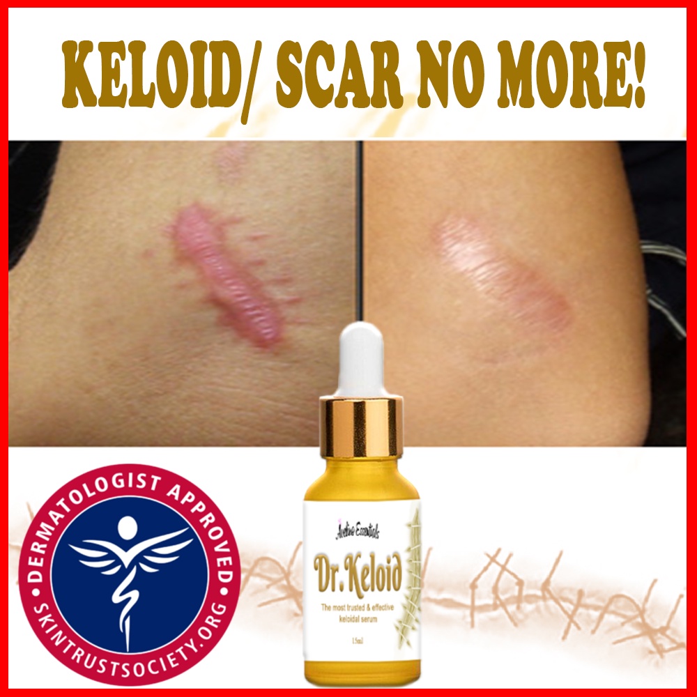 Keloid Scar Treatment Aspirin at Jesse Bowlin blog