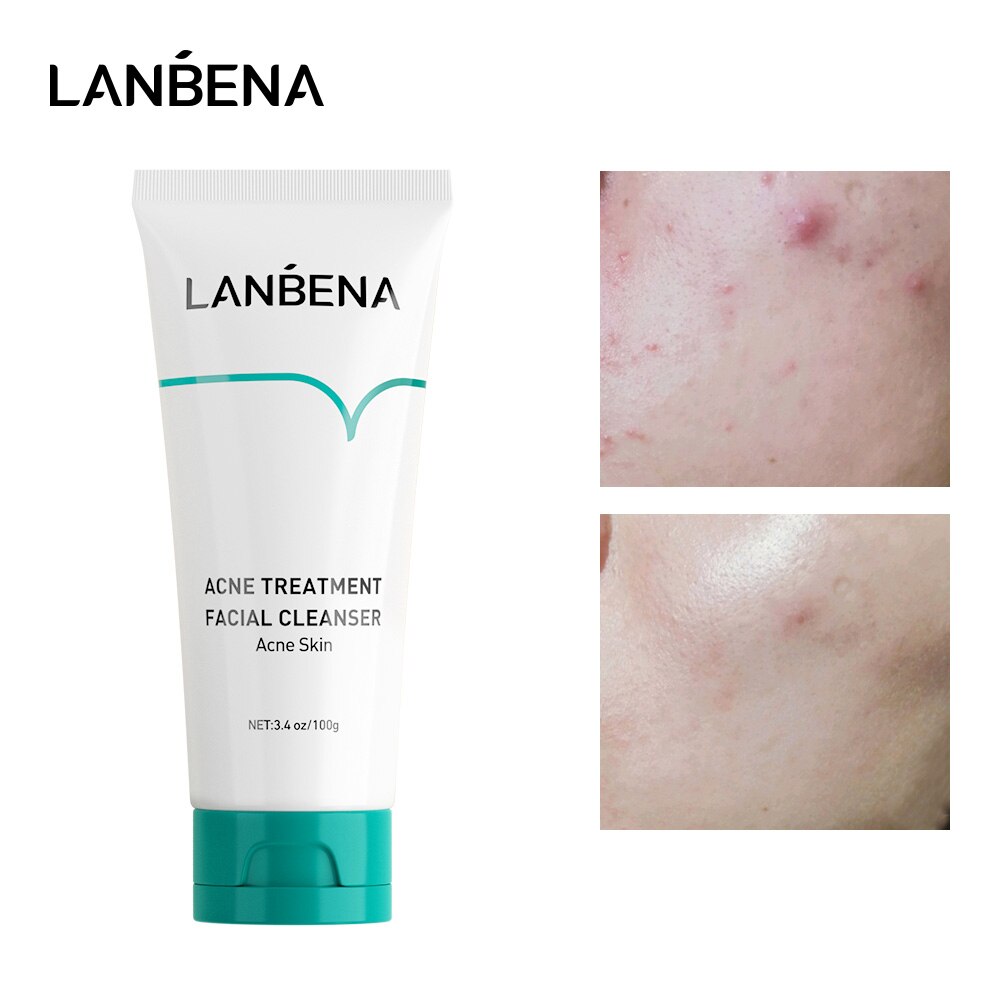 LANBENA Acne Treatment Facial Cleanser Wash Anti Pimple Oil Control