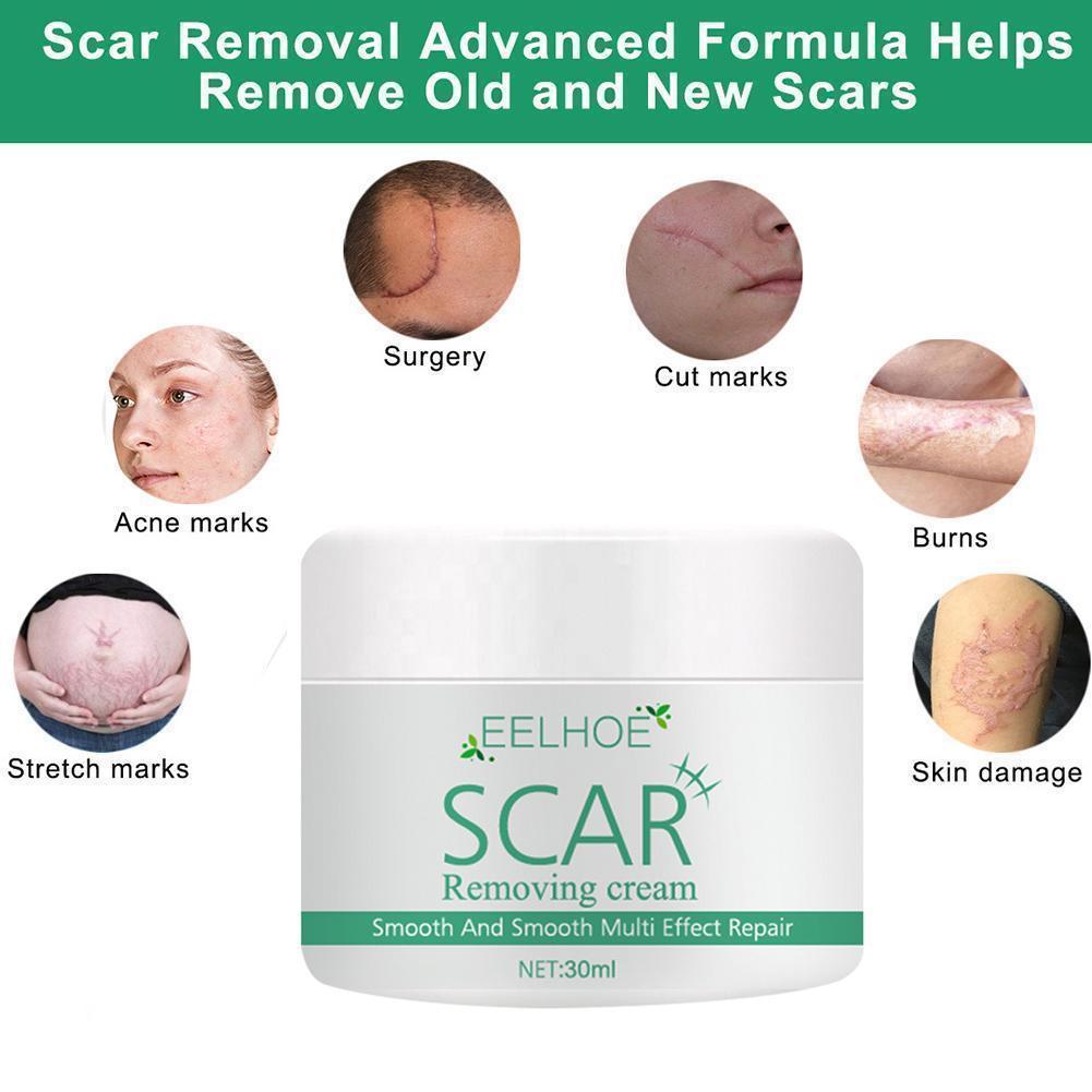 eelhoe scar removal cream