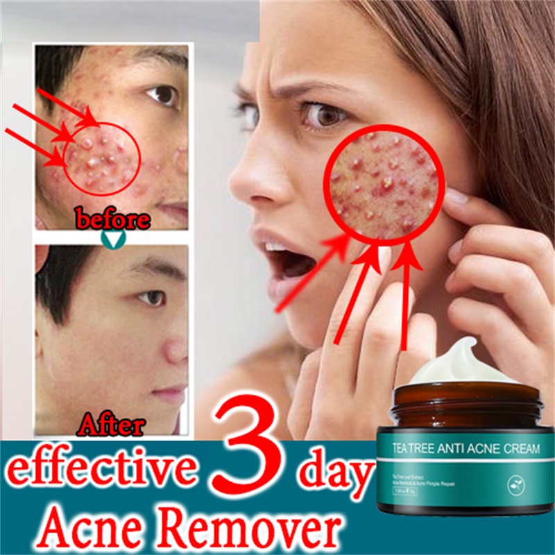 SKIN EVER AntiAcne Pimple cream,quickly&effectively remove acne,fade