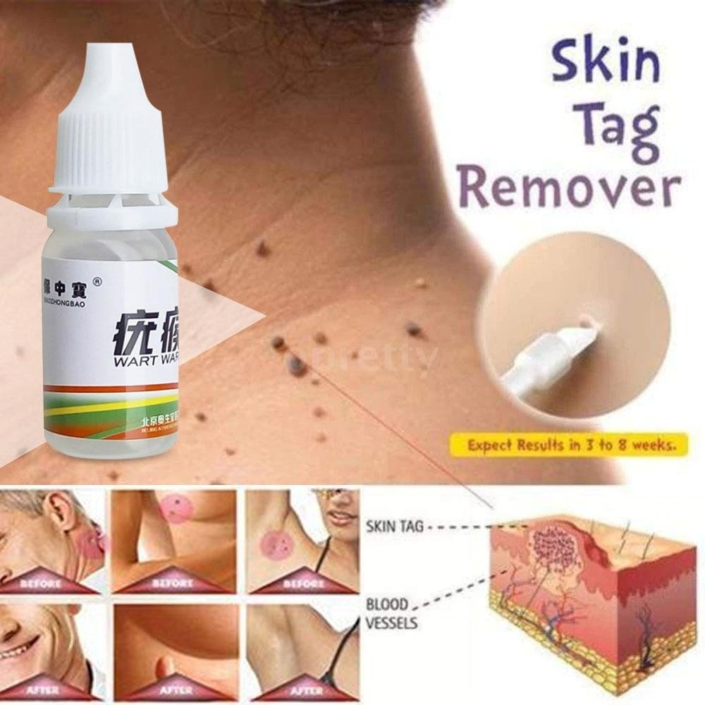 Skin Tag Remover Medical Tu Kill Remover Warts Treatment Foot Corn