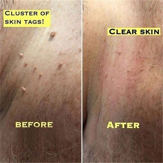 Ultra Strength Natural Health Mole Nevus Wart Skin Foot Tag Warts Tag Removal Corn Skin O3X5 #9
