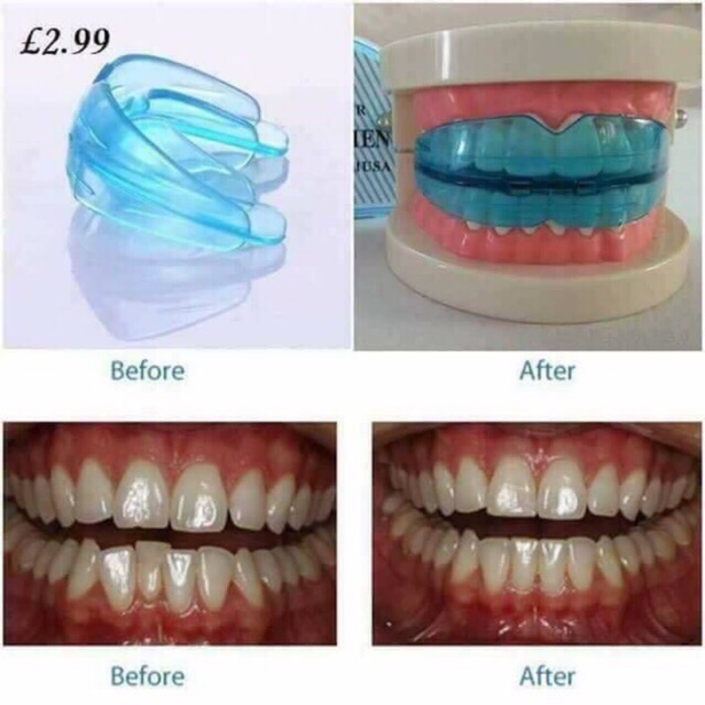 silicone teeth alignment