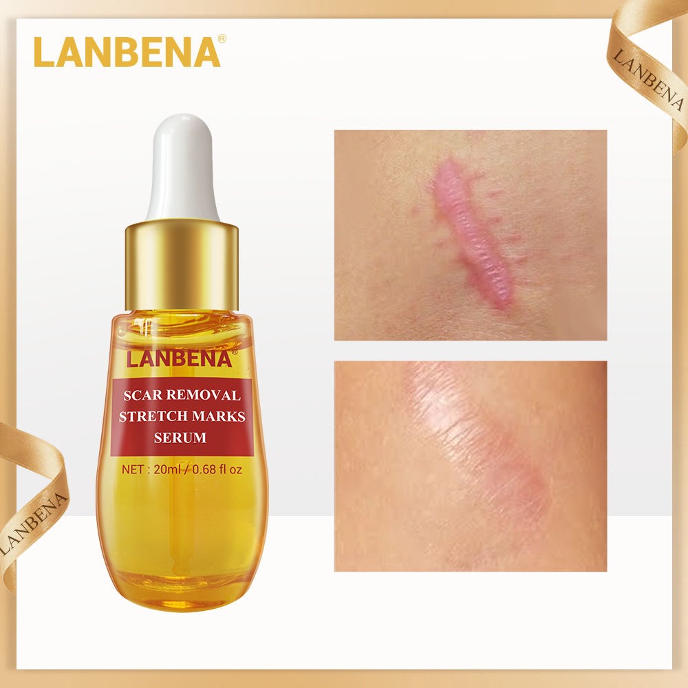 LANBENA Acne Scar Remove Serum Treatment Stretch Marks Anti Shrink ...