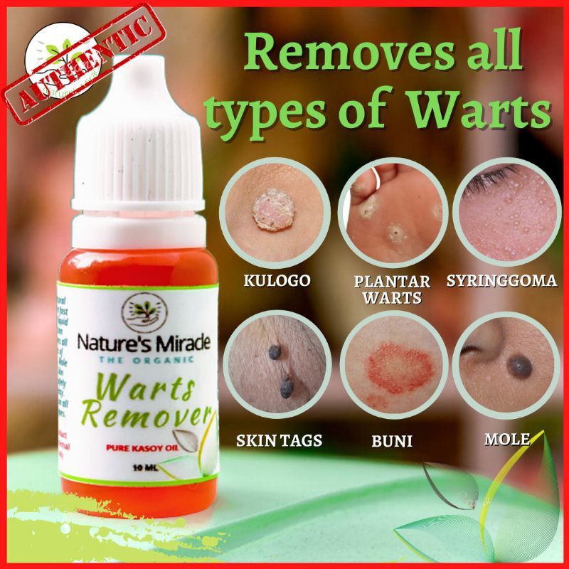 Pure And Effective Kasoy Oil Warts Mole Skin Tag Kulugo Genital Warts Any Unwanted Skin Growth