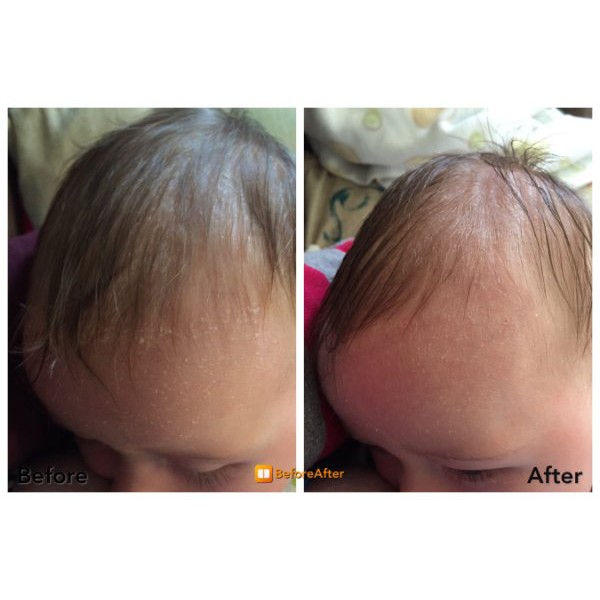 moogoo cradle cap
