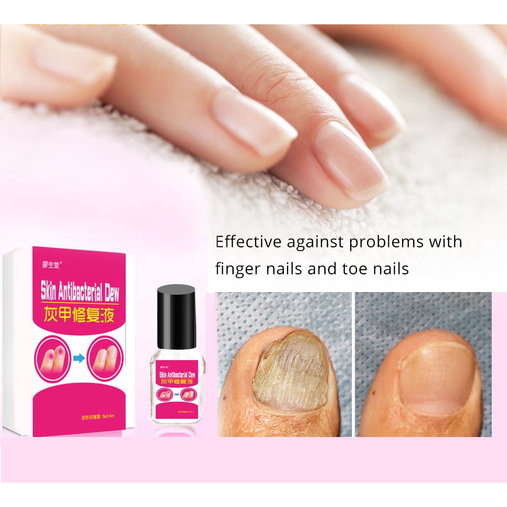 Onychomycosis Paronychia Anti Fungal Nail Infection Toe Nail Fungus ...