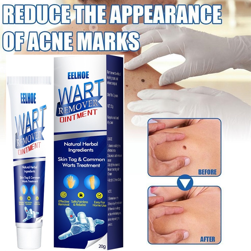 Warts Remover Cream Wart Removal Ointment Wart Treatment Skin Tags Mole Corn Plaster