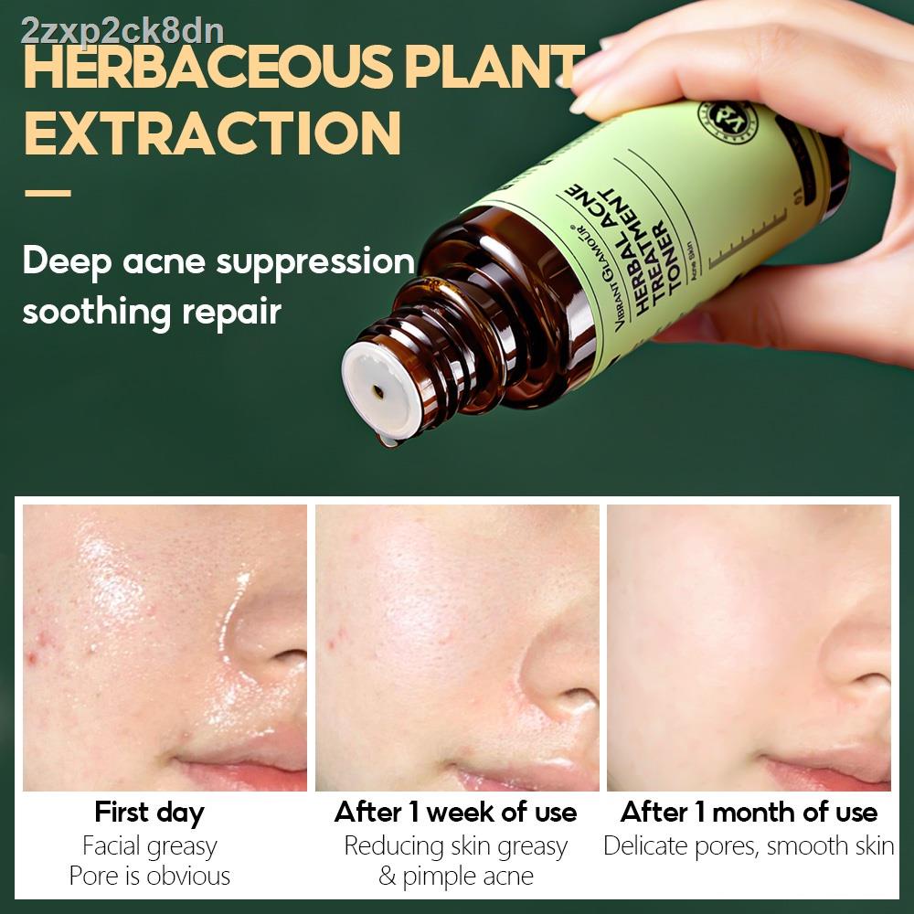 【Factory price】▧∏℡◆VIBRANT GLAMOUR Herbal Acne Treatment Toner Deep Repair Soothing Skin Reduce Pim