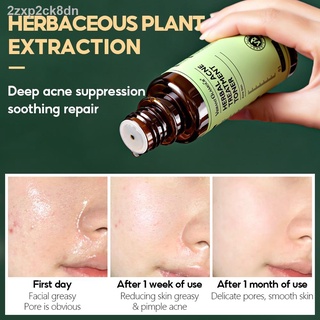 【Factory price】▧∏℡◆VIBRANT GLAMOUR Herbal Acne Treatment Toner Deep Repair Soothing Skin Reduce Pim #4