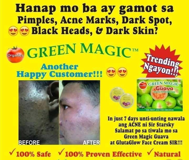 gamot sa acne pimples