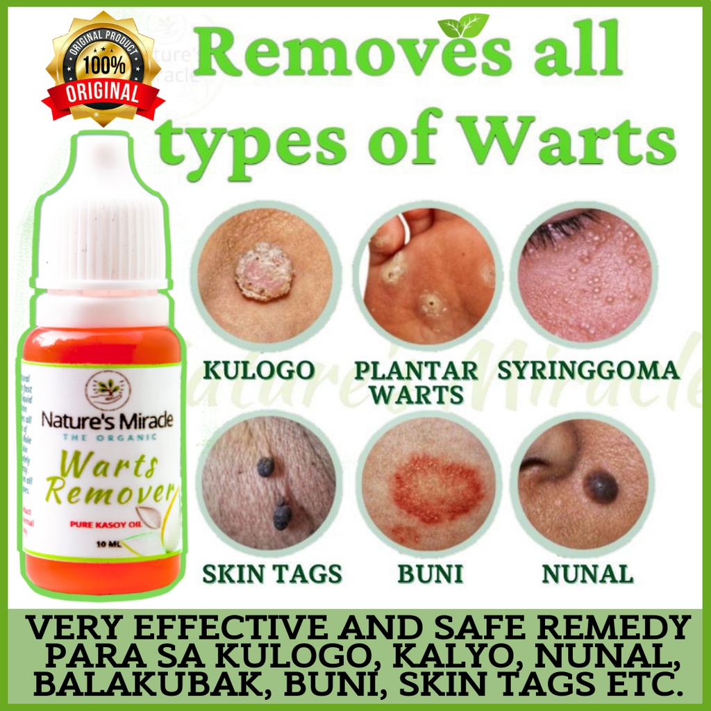 Warts Remover Original 100 Organic Kasoy Oil Very Effective For Warts