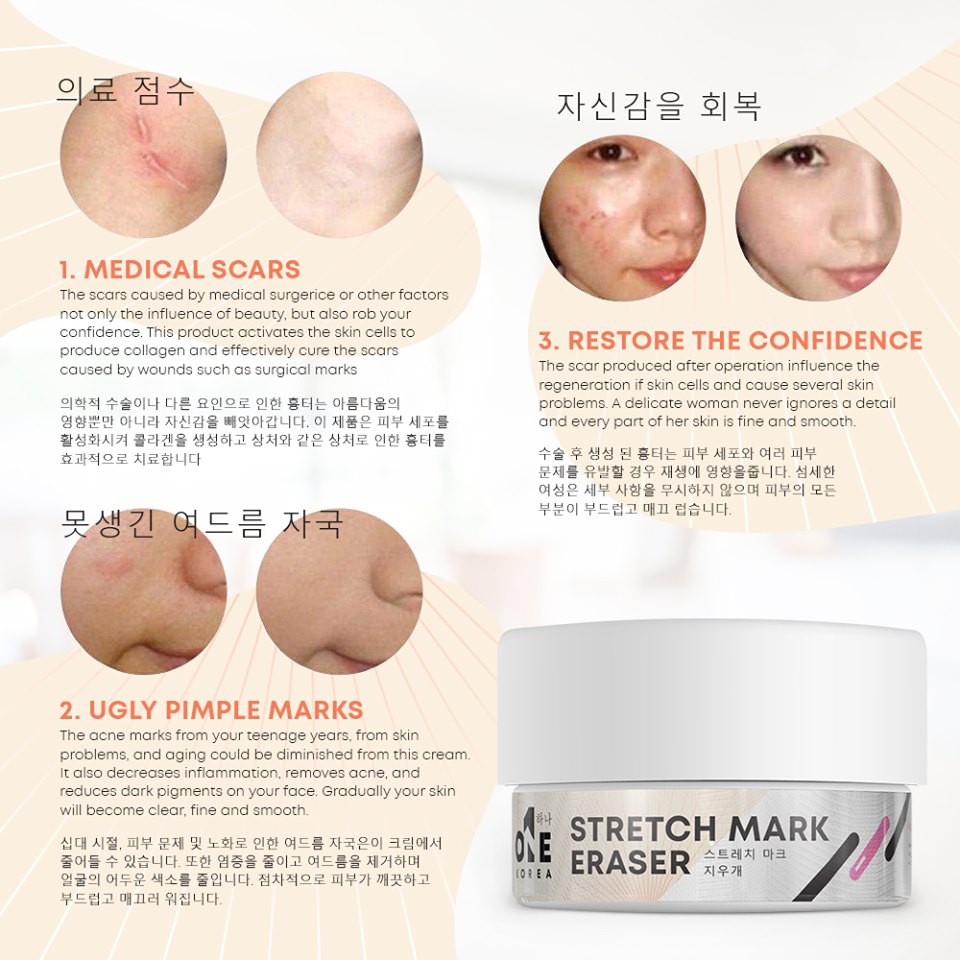 eraser cream for stretch marks