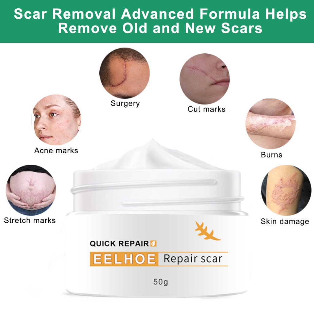Image showcasing EELHOE old Scar Remover for legs 50g peklat remover acne Surgical ...