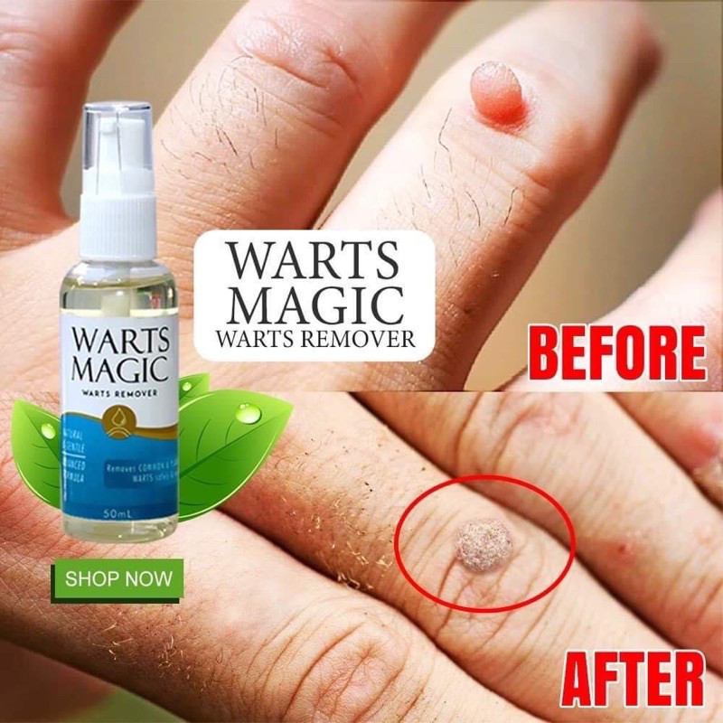 WARTS MAGIC Warts Remover Shopee Philippines