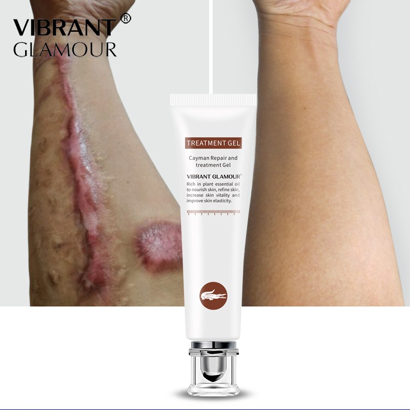 VG Acne Scar Remover Gel Serum Cream Scars Repair Stretch Marks