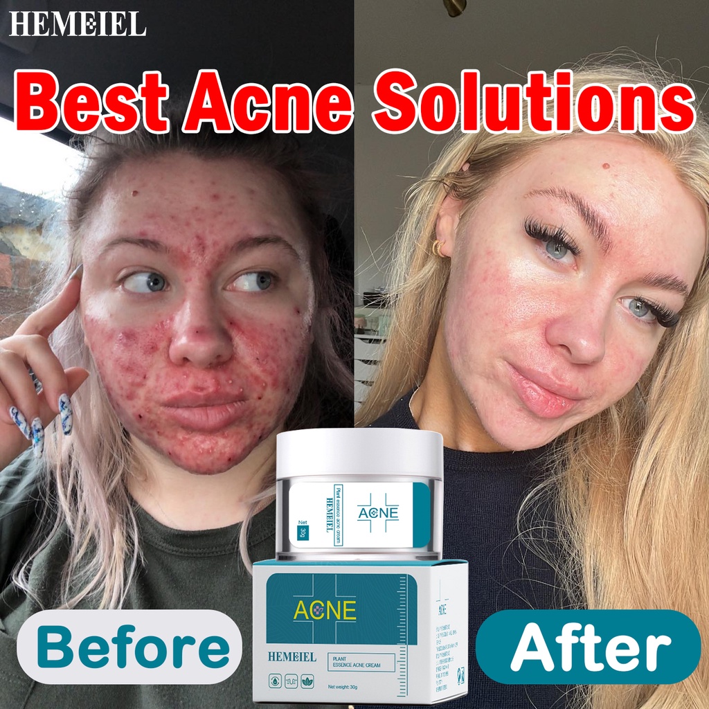HEMEIEL acne treatment cream benzoyl peroxide 5 pimple remover
