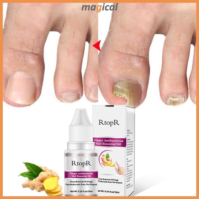 Ginger Antibacterial Nail Treatment Onychomycosis Paronychia Anti