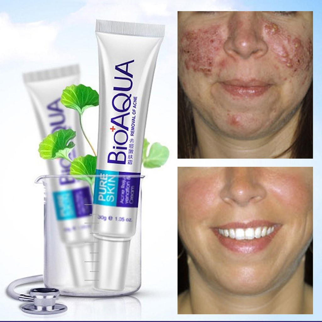 Bioaqua Acne Removal Scar Marks Cream Whitening Cream Shopee Philippines