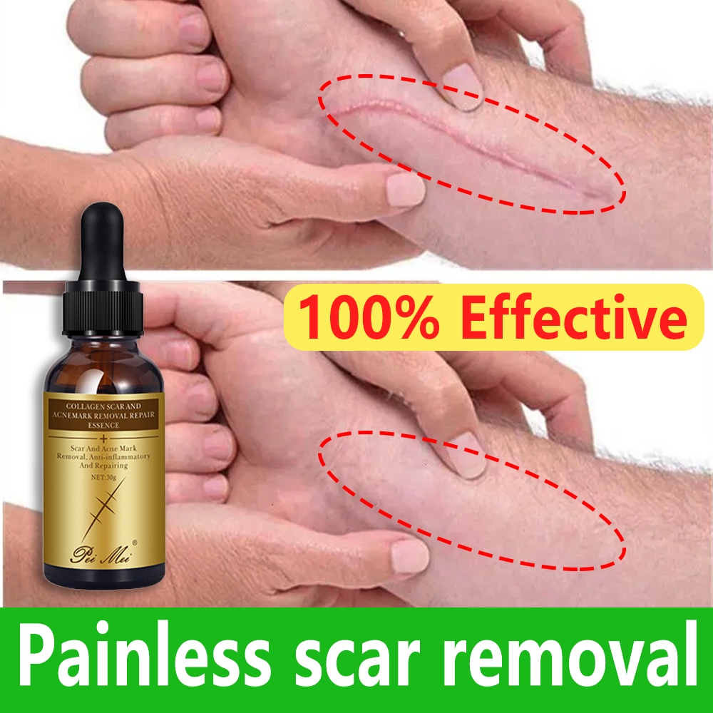 iflHScar remover serum 30ML Fix scar removal Acne Scar Remover