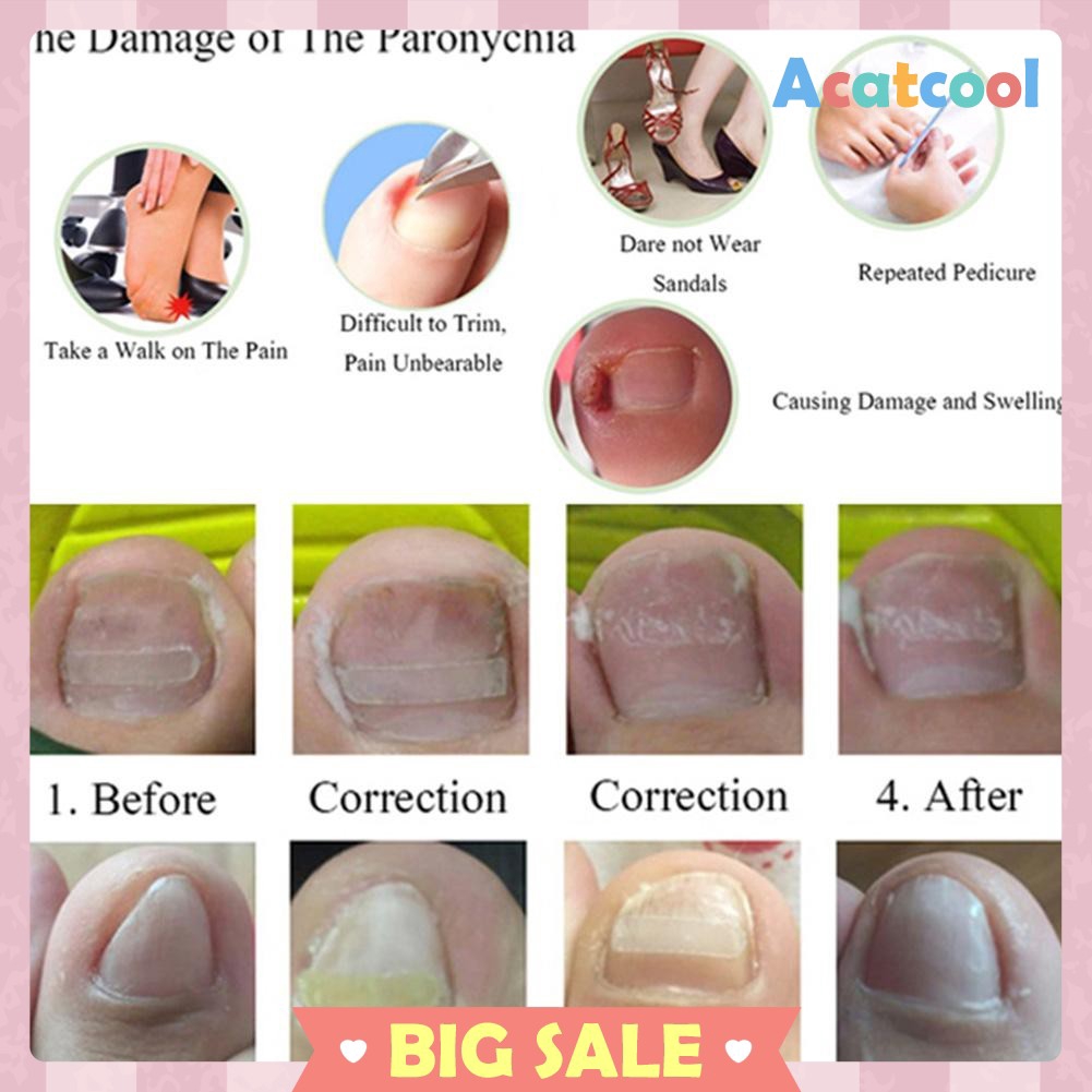 Ingrown Toenail Brace Treatment Nail Ftempo