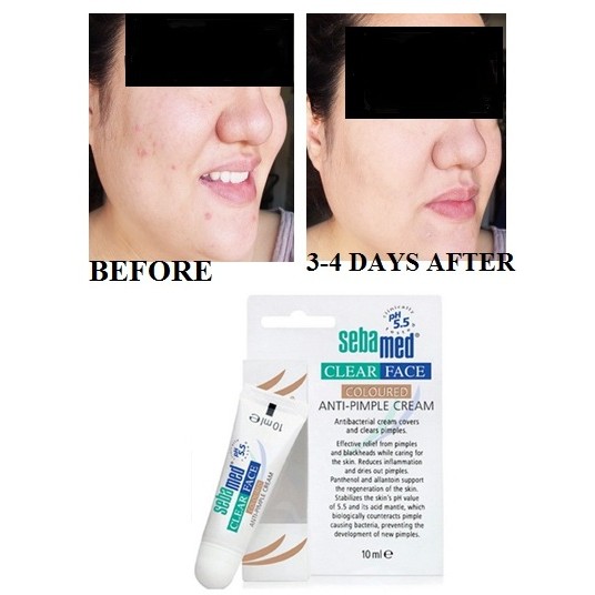 sebamed colored anti pimple cream