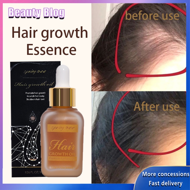 30ML Hair Growth Essential Oil Scalp Treatment AntiHair Loss Scalp