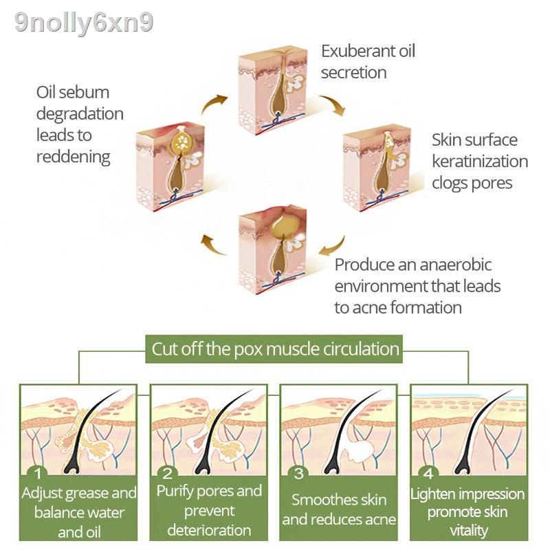 【Factory price】▧VIBRANT GLAMOUR Tea Tree Oil Acne Pimples Scars Treatment Facial Toner 30ml