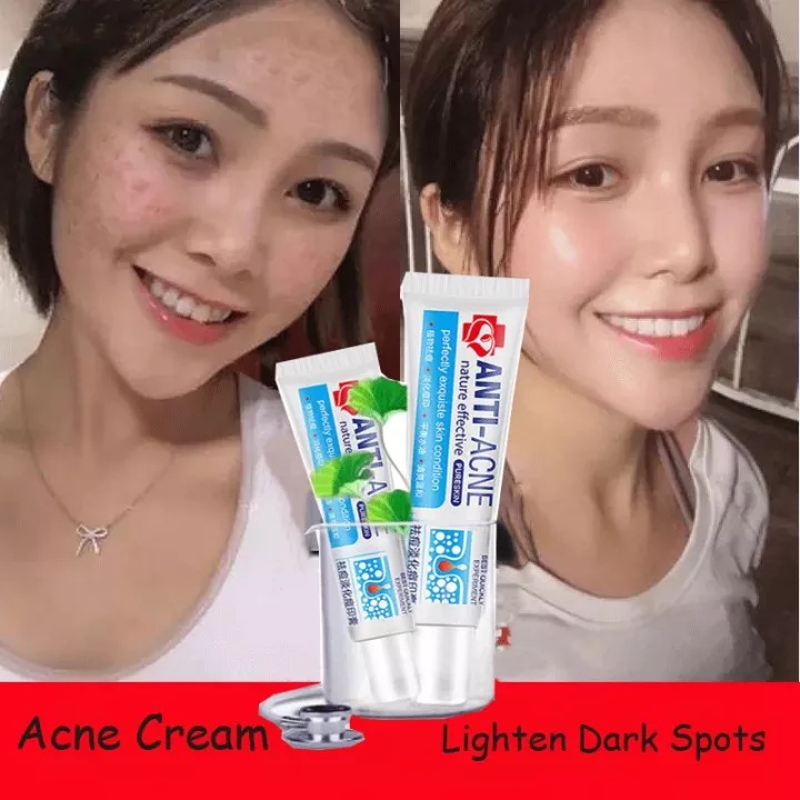 Acne Cream Remove Pimples Quickly Pimple Remover Acne Cream Fades Acne