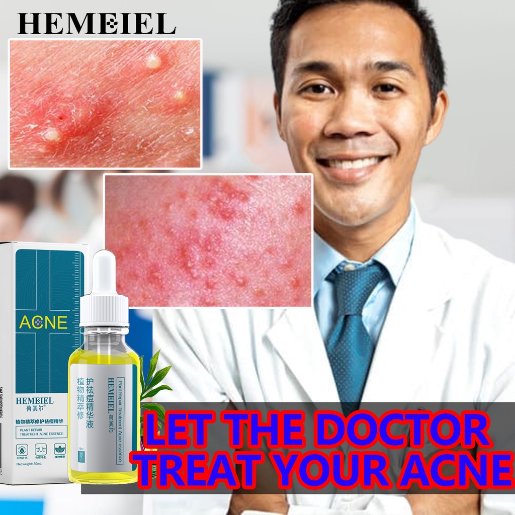 HEMEIEL Fade Back Acne Marks/Teen Acne Creams/Benzac Benzoyl Peroxide