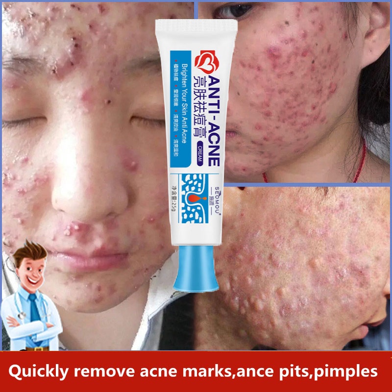 Acne Cream Pimples Cream Acne Vulgaris Skincare Restores The Perfect