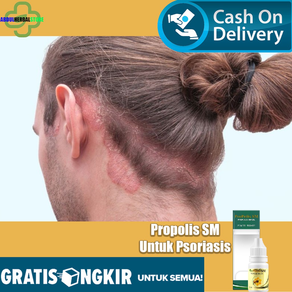 Scalp Psoriasis Medicines Scalp Itching Hair Itching Treatment Medicine