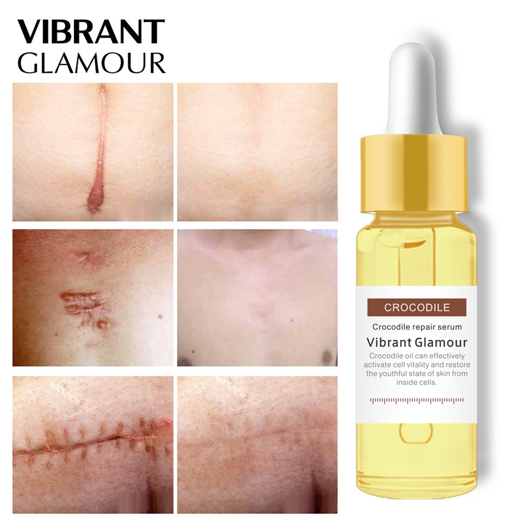 serum for deep acne scars