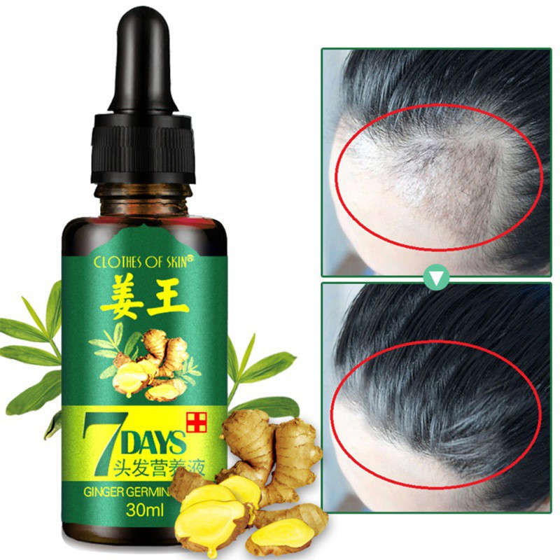 Hair Loss Treatment Ginger Hair Growth Oil For Thicker Hair