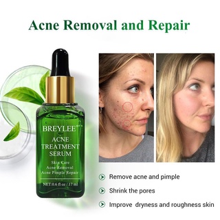 Low price activity Breylee Acne Treatment Set 6 pcs (facial cleanser,acne scars removal gel ,serum , #5