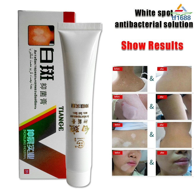 Chinese Herbal Cream For Vitiligo White Spots Leukoplakia Disease