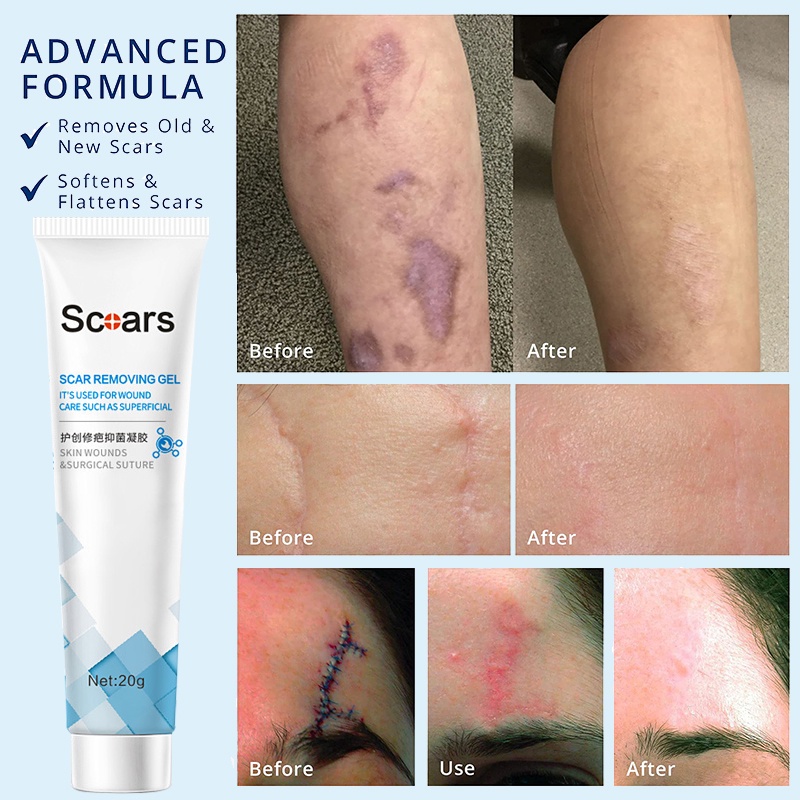 Scar remover gel cream 20g Fade acne scars stretch marks repair and