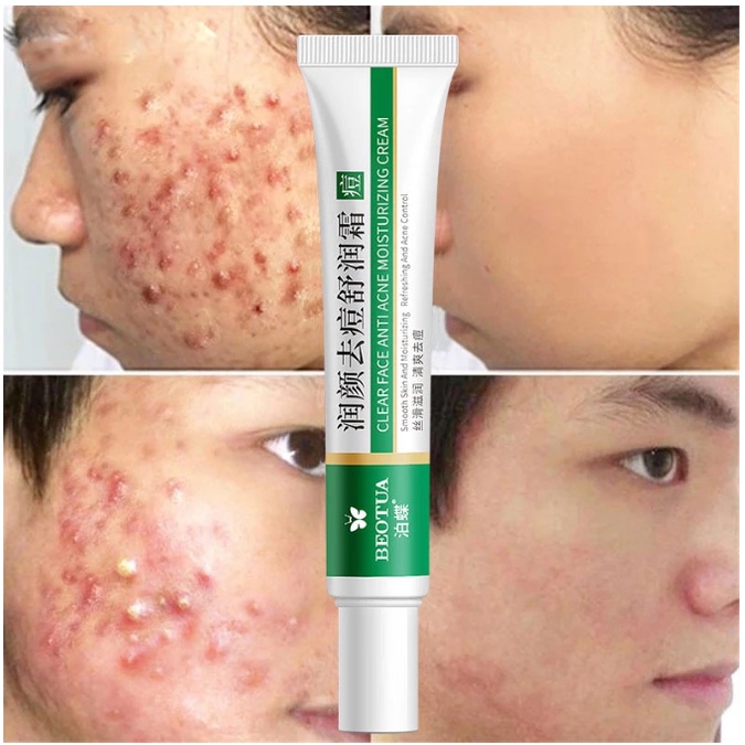 Effective Acne Removal Cream Herbal Spots Acne Oil Control Acne Cream