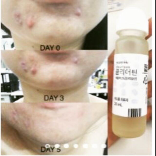 clearteen acne