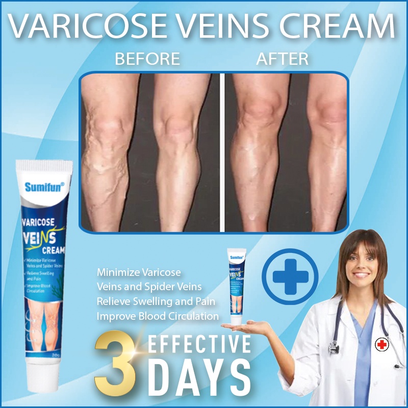 varicose veins effective remover cream varicose vein remover cream and