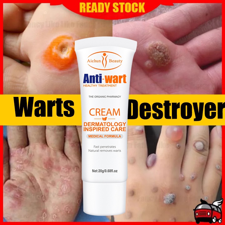 Warts Remover Cream Original Wartz Removal Cream Growth Warts Remover Mole And Warts Remover 20g 9332