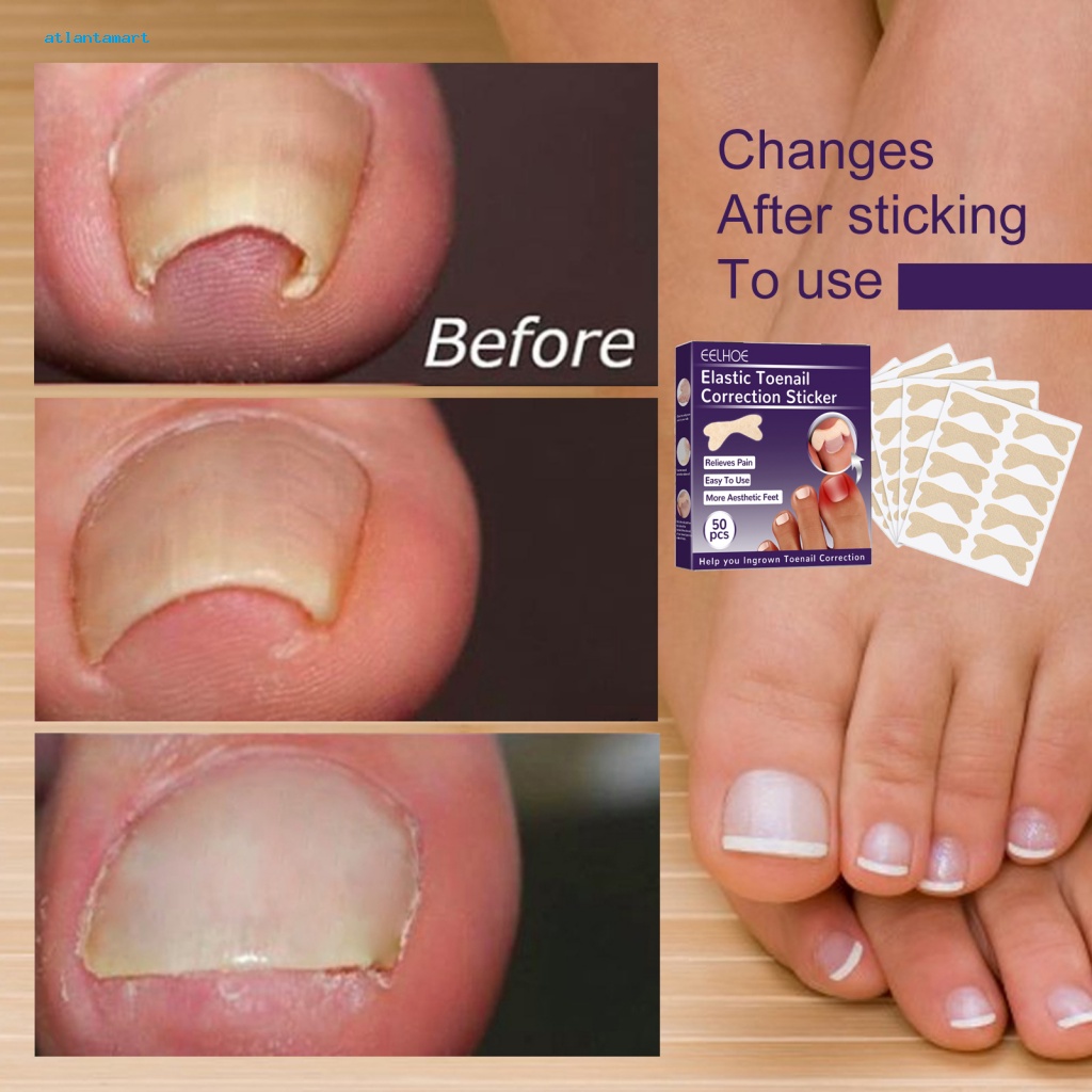 Atl DropDown Toenail Corrector Stickers Pedicure Care Toenail Ingrown