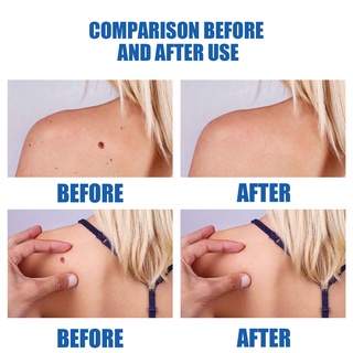 Skin Mole Removal Pen Remover Anti Verruca Remedy Liquid Pen Without Leaving Scars #5